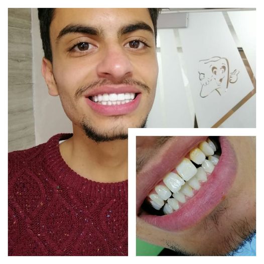 فيسنج الأسنان في الأردن