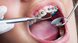 Orthodontics In Jordan